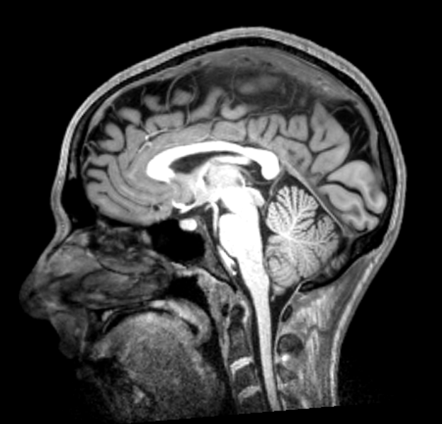 An MRI image of my brain.