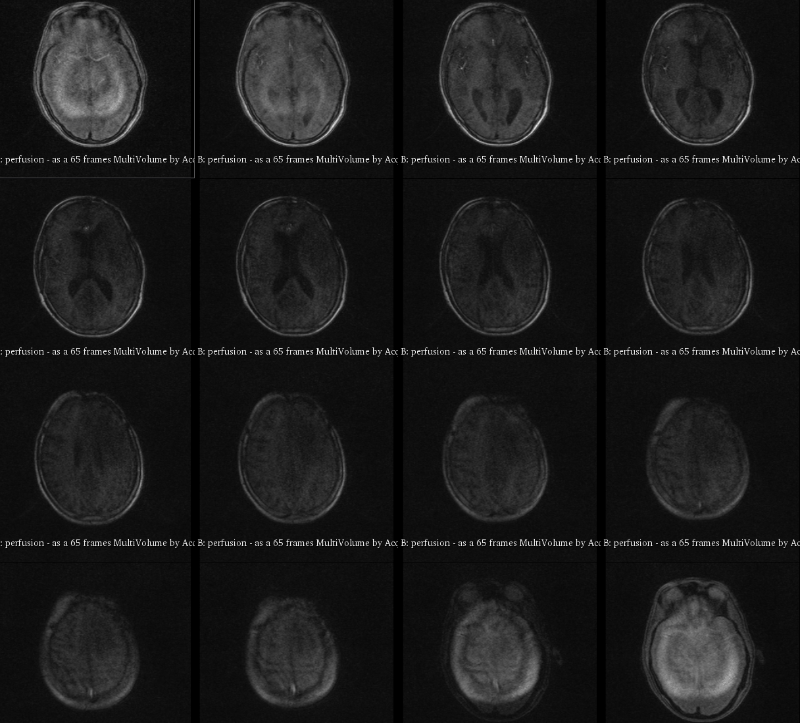 16 animated panels in a 4x4 grid showing how a constrast agent is taken up by the brain in DCE-MRI, particularly in the case of someone with a tumor. Panels start relatively monochrome and grey, but then certain parts of the panels where the tumors and veins are located get brighter.